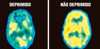 Nova pesquisa diz que a depressão é uma forma de dano cerebral